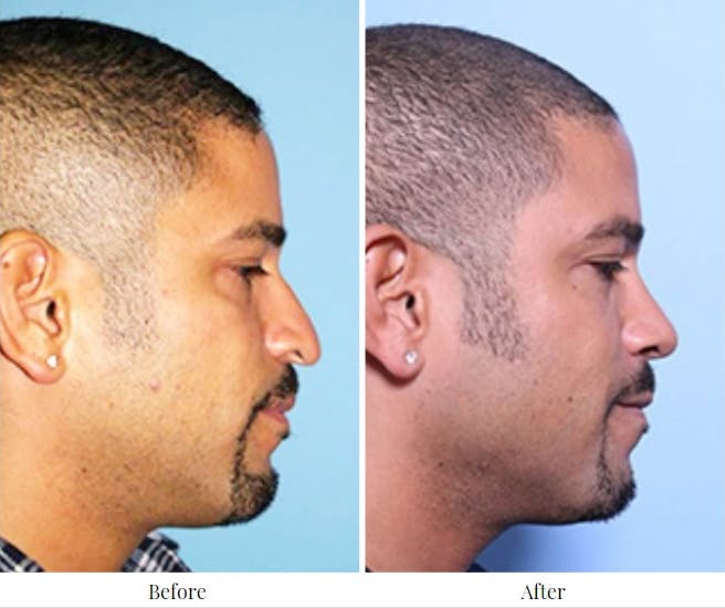 Rhinoplasty Before & After Gallery - Patient 64081021 - Image 1