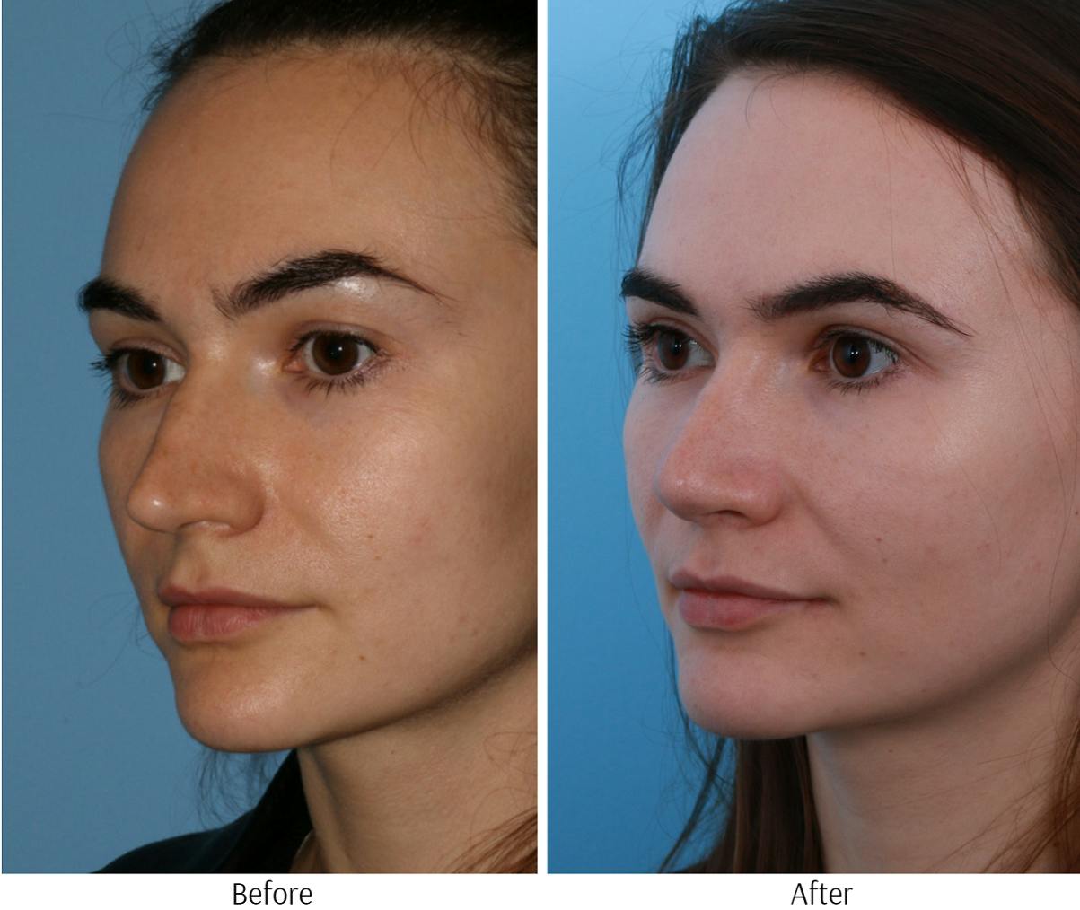 Rhinoplasty Before & After Gallery - Patient 64081018 - Image 2