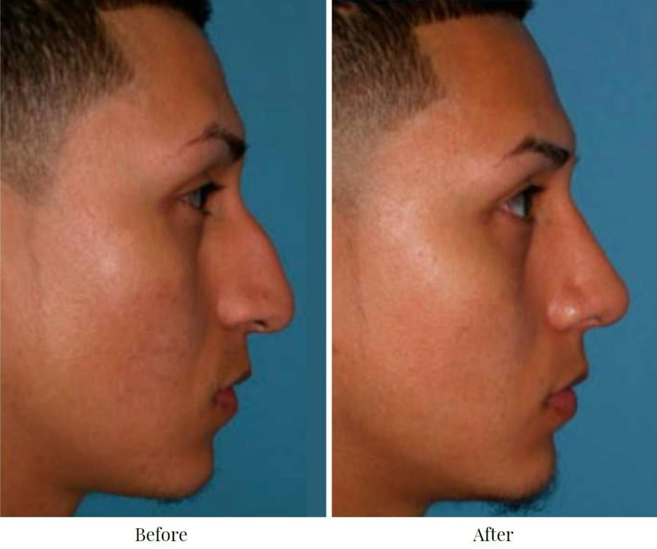 Rhinoplasty Before & After Gallery - Patient 64081001 - Image 2