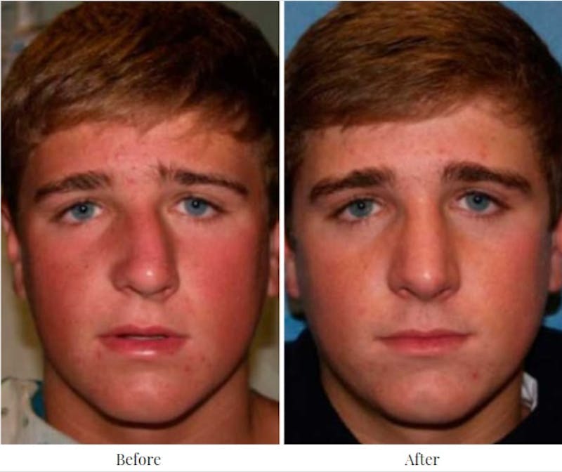 Rhinoplasty Before & After Gallery - Patient 64081000 - Image 1