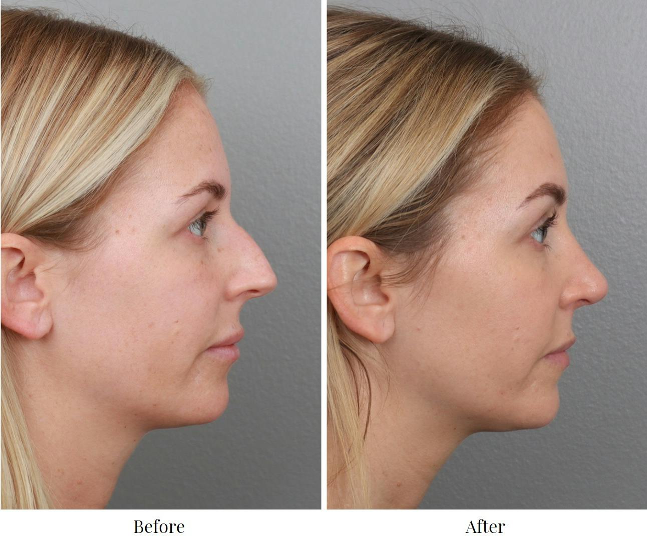 Rhinoplasty Before & After Gallery - Patient 64080999 - Image 1