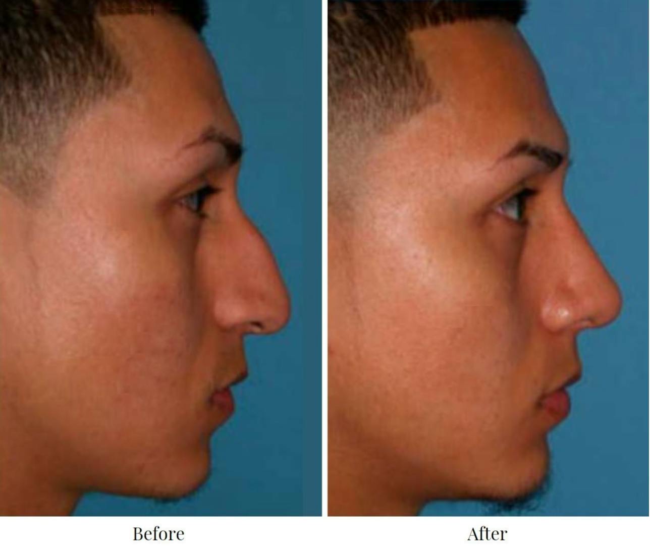 Rhinoplasty Before & After Gallery - Patient 64081001 - Image 1