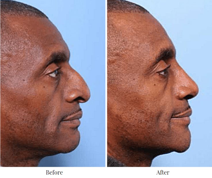 Rhinoplasty Before & After Gallery - Patient 64080973 - Image 2