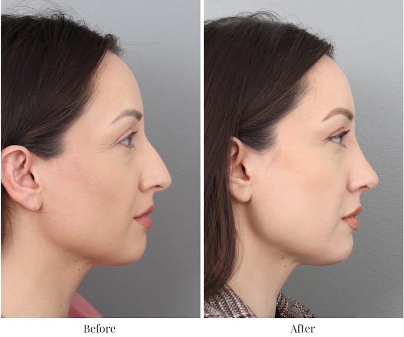 Rhinoplasty Before & After Gallery - Patient 64080975 - Image 1