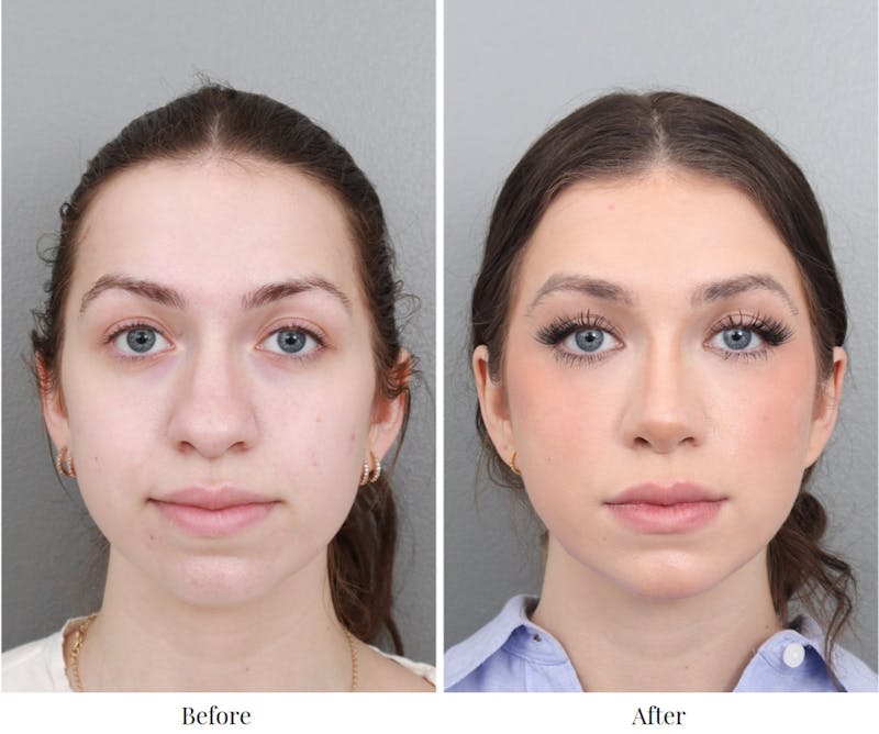 Rhinoplasty Before & After Gallery - Patient 64080982 - Image 1