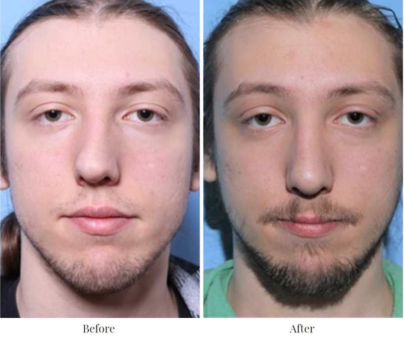 Rhinoplasty Before & After Gallery - Patient 64080998 - Image 1