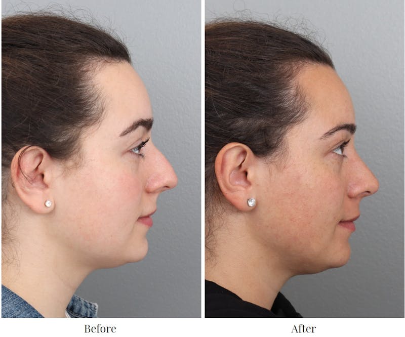 Rhinoplasty Before & After Gallery - Patient 64080983 - Image 1