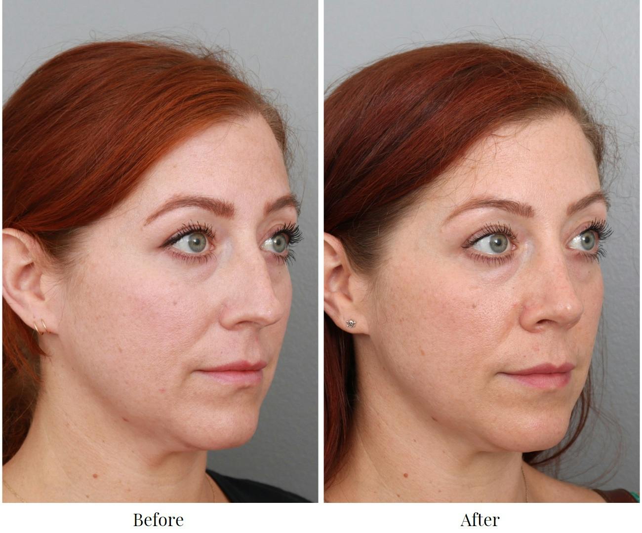 Rhinoplasty Before & After Gallery - Patient 64080986 - Image 1