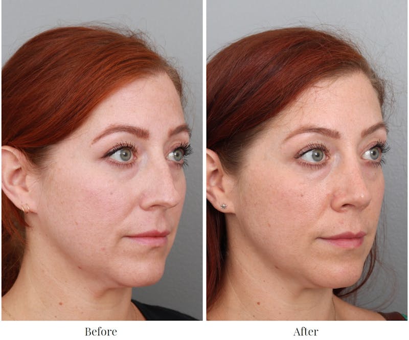 Rhinoplasty Before & After Gallery - Patient 64080986 - Image 1