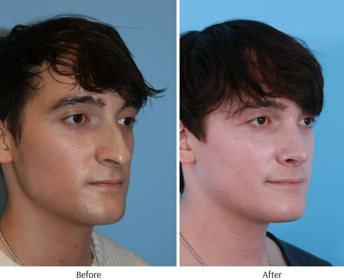 Patient 64080945 Rhinoplasty Before & After Photos Gold Coast
