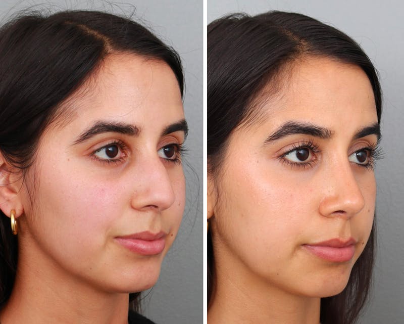 Rhinoplasty Before & After Gallery - Patient 64080949 - Image 1