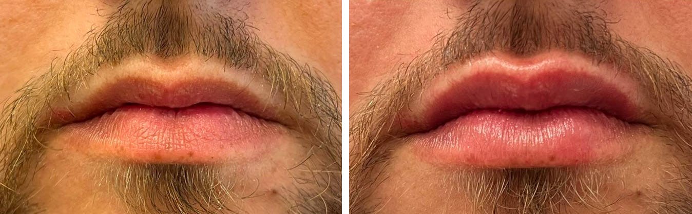 Lip Augmentation Before & After Gallery - Patient 94779221 - Image 1