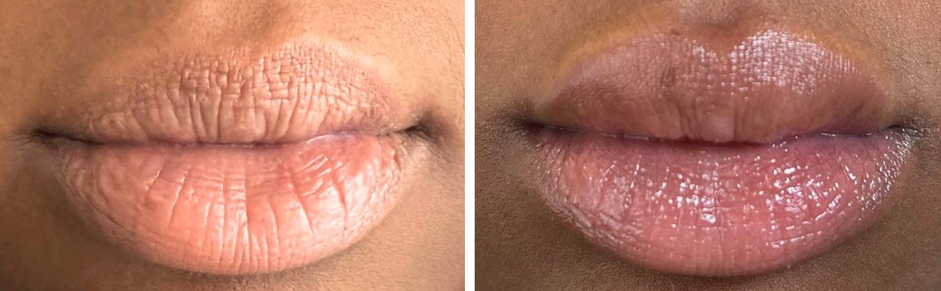 Lip Augmentation Before & After Gallery - Patient 94779220 - Image 1