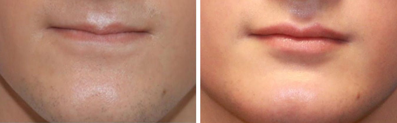 Lip Augmentation Before & After Gallery - Patient 64081187 - Image 1