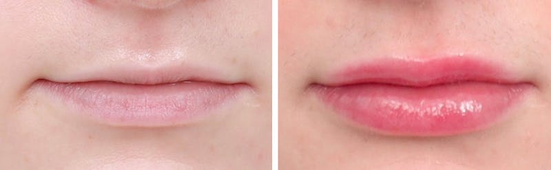 Lip Augmentation Before & After Gallery - Patient 94810017 - Image 1