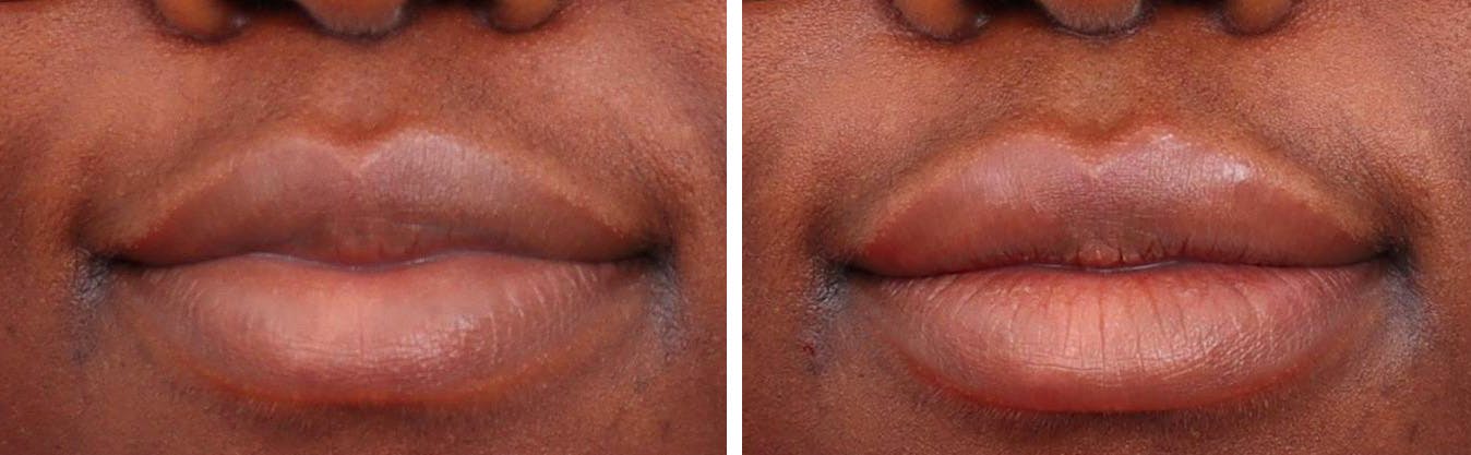 Lip Augmentation Before & After Gallery - Patient 94810019 - Image 1