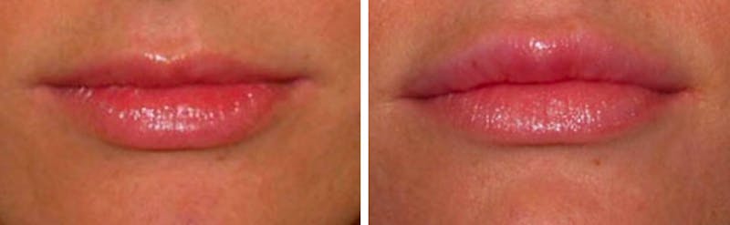Lip Augmentation Before & After Gallery - Patient 94810018 - Image 1