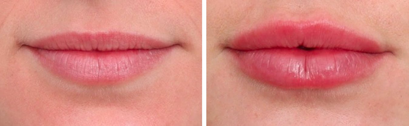 Lip Augmentation Before & After Gallery - Patient 72506056 - Image 1