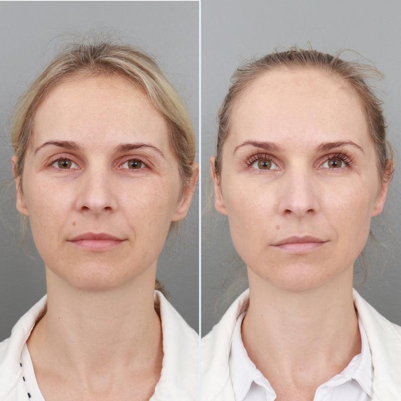 NonSurgical Facelift Gallery Gold Coast Plastic Surgery