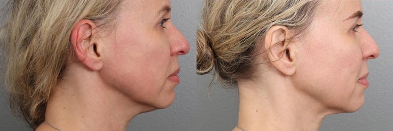 Laser Resurfacing Before & After Gallery - Patient 104569081 - Image 1