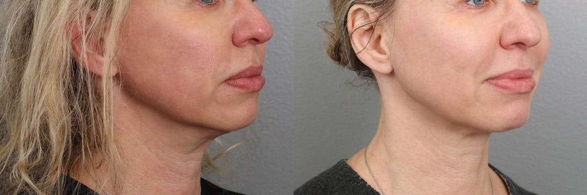 Laser Resurfacing Before & After Gallery - Patient 104569081 - Image 2