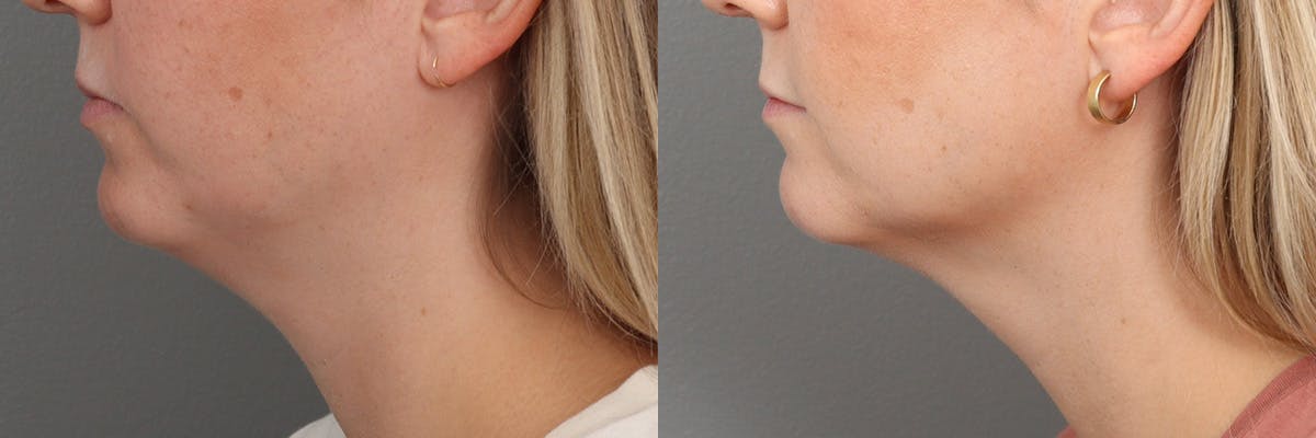 Laser Resurfacing Before & After Gallery - Patient 104569080 - Image 1