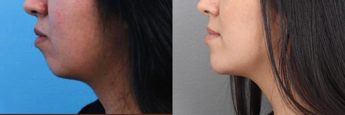 Jawline/Chin Before & After Gallery - Patient 104569094 - Image 1