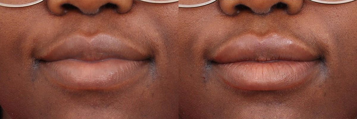 Lip Augmentation Before & After Gallery - Patient 104569129 - Image 1
