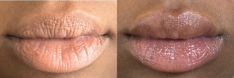 Lip Augmentation Before & After Gallery - Patient 104569128 - Image 1