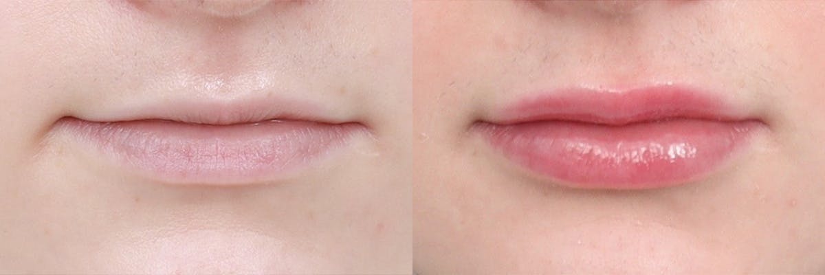 Lip Augmentation Before & After Gallery - Patient 104569127 - Image 1