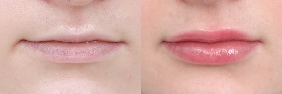 Lip Augmentation Before & After Gallery - Patient 104569127 - Image 1