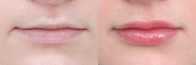Lip Augmentation Before & After Gallery - Patient 104569127 - Image 1