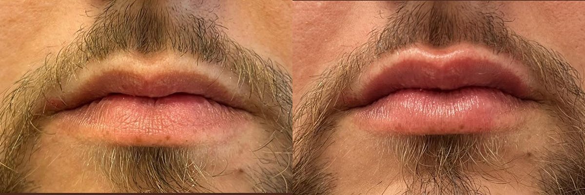 Lip Augmentation Before & After Gallery - Patient 104569126 - Image 1