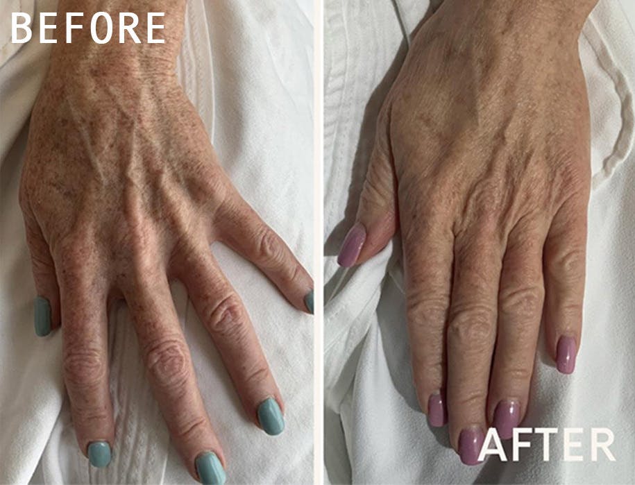 Laser Resurfacing Before & After Gallery - Patient 101345689 - Image 1