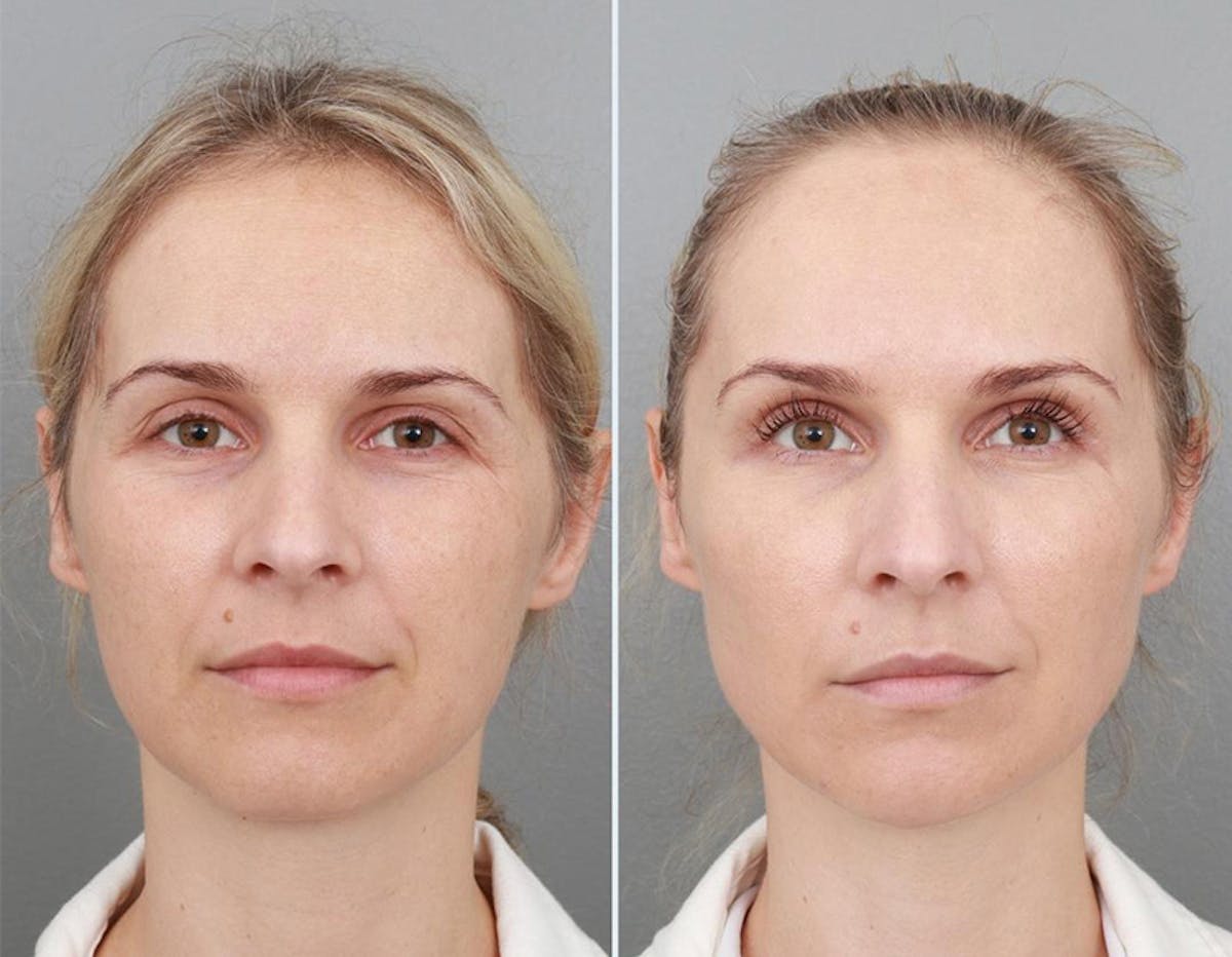 Non-Surgical Facelift Before & After Gallery - Patient 94810388 - Image 1