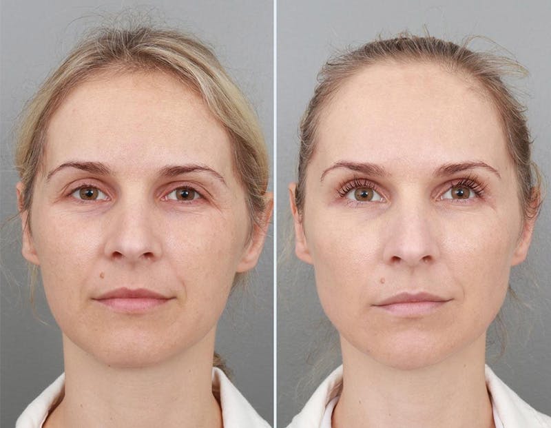 Non-Surgical Facelift Before & After Gallery - Patient 94810388 - Image 1