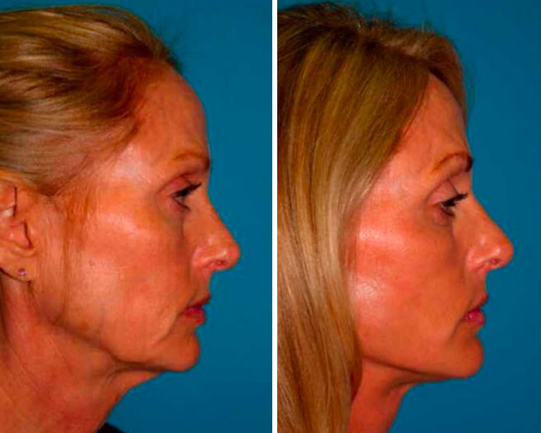 Facelift Before & After Gallery - Patient 64081067 - Image 2