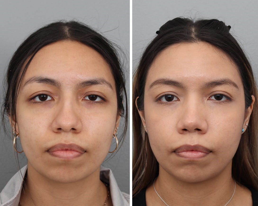 Rhinoplasty Before & After Gallery - Patient 106474528 - Image 2