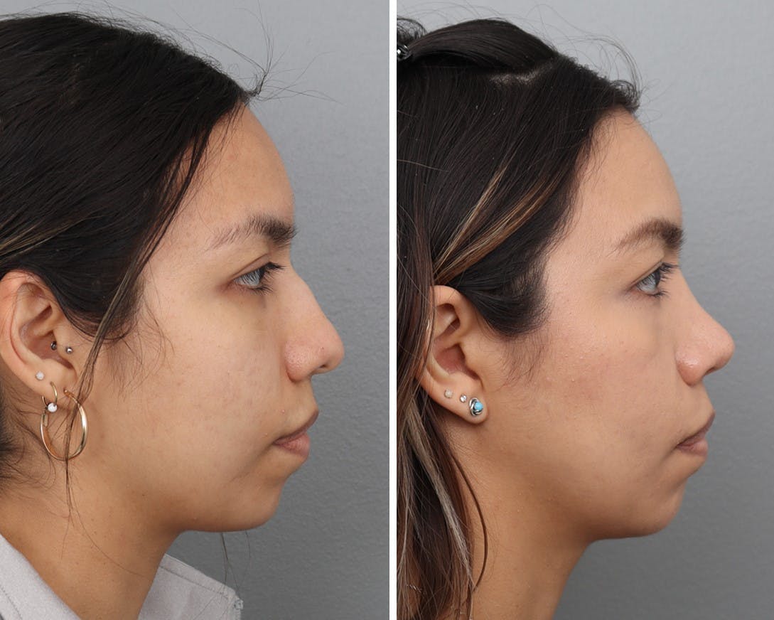 Rhinoplasty Before & After Gallery - Patient 106474528 - Image 3