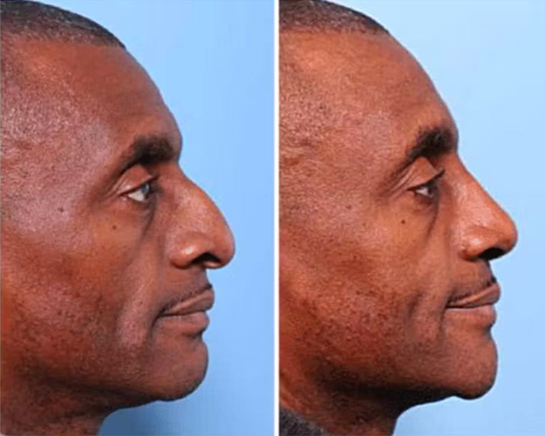 Rhinoplasty Before & After Gallery - Patient 64080973 - Image 1