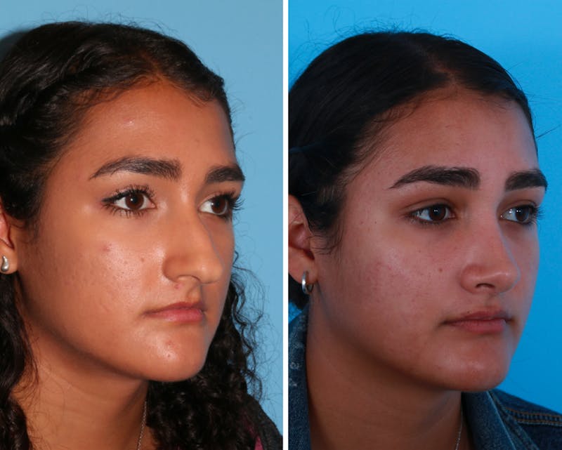 Rhinoplasty Before & After Gallery - Patient 64080987 - Image 1