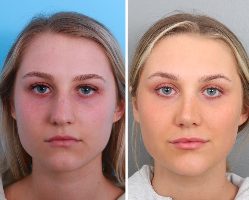 Rhinoplasty Before & After Gallery - Patient 64080985 - Image 1