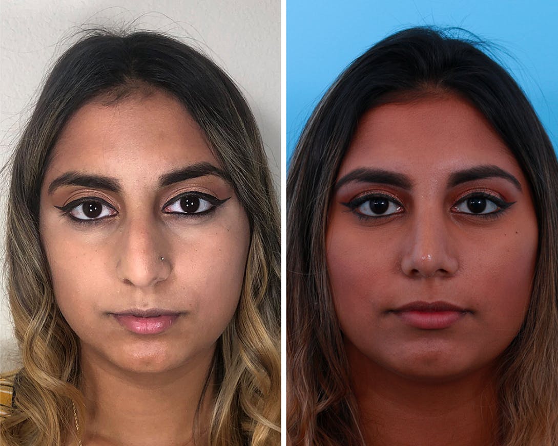 Rhinoplasty Before & After Gallery - Patient 64080974 - Image 1