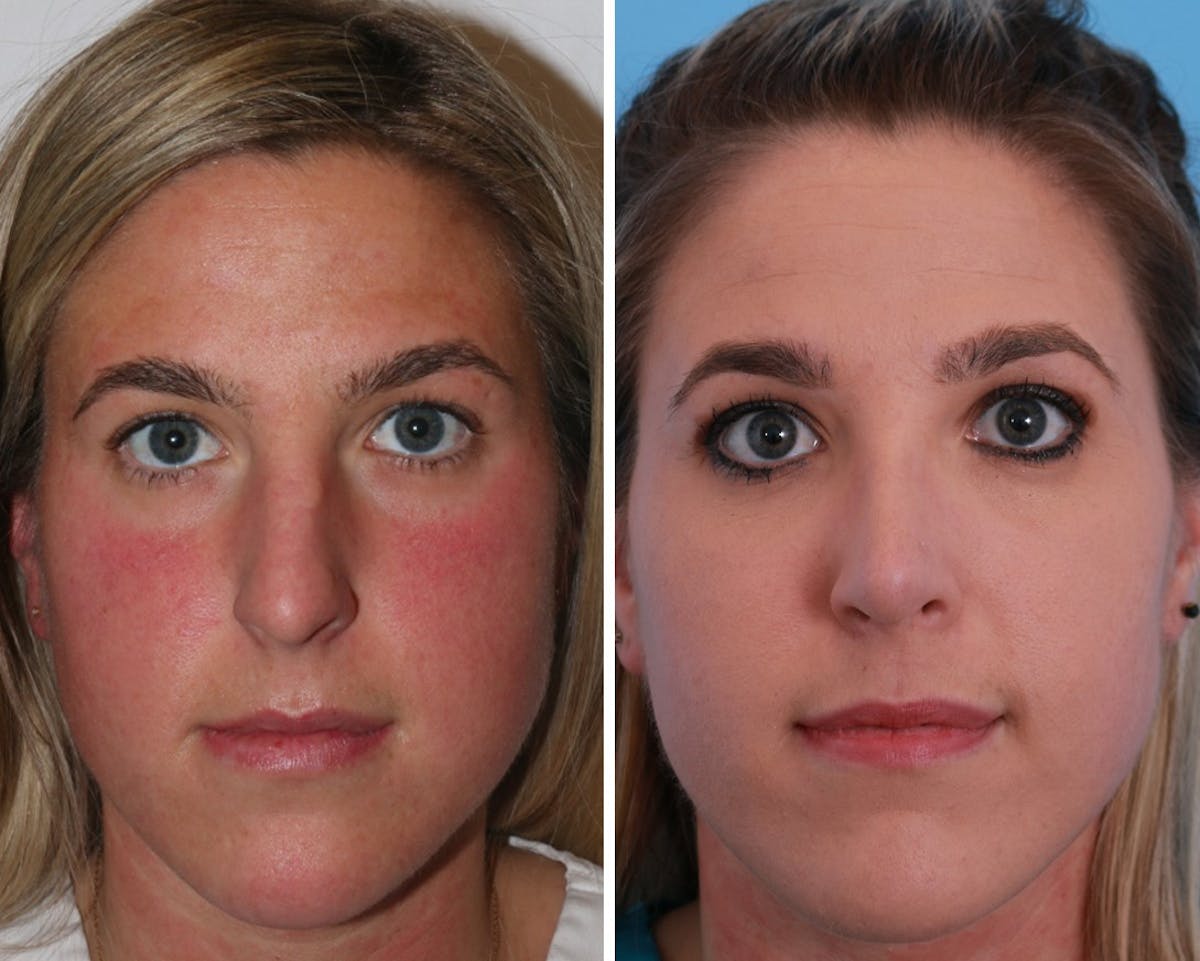 Rhinoplasty Before & After Gallery - Patient 64080988 - Image 1