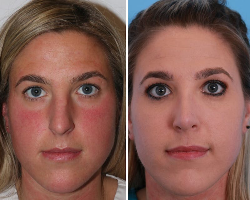 Rhinoplasty Before & After Gallery - Patient 64080988 - Image 1