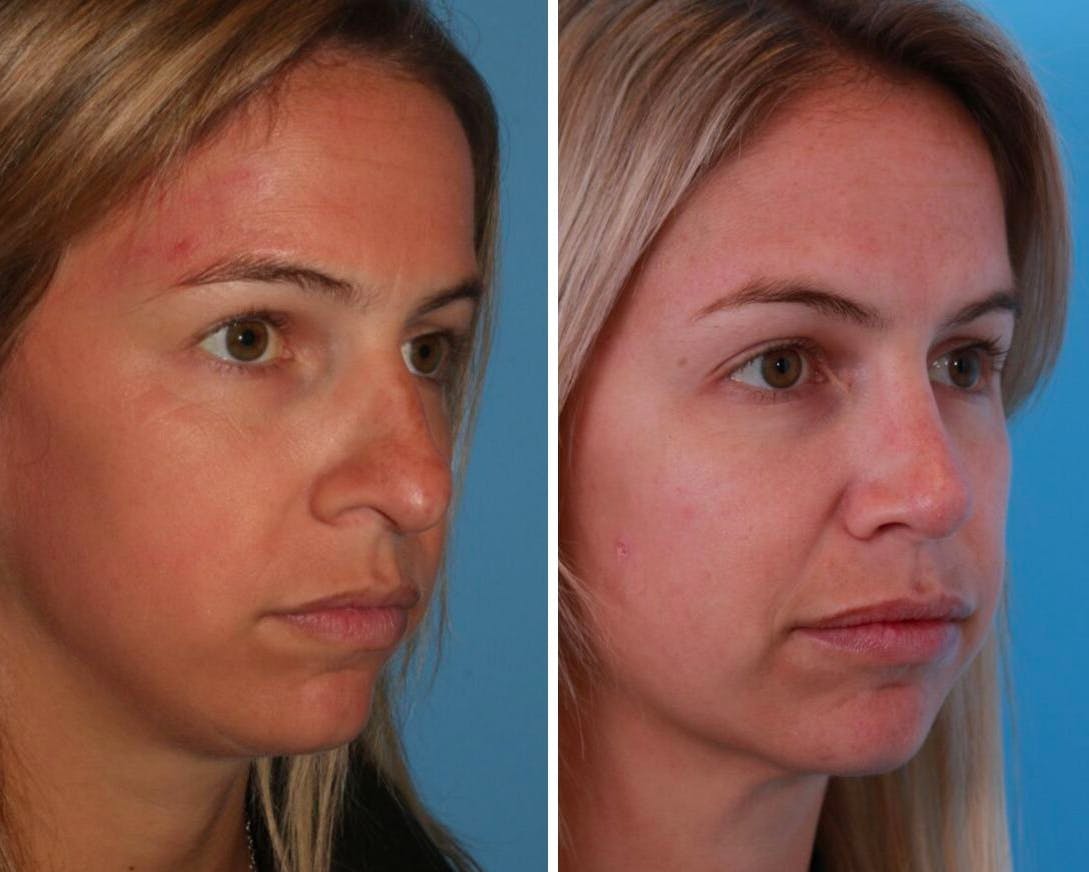 Rhinoplasty Before & After Gallery - Patient 64081020 - Image 1