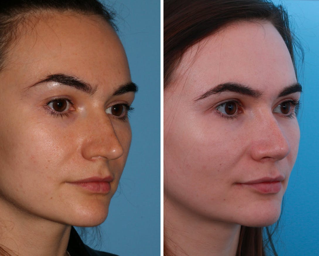 Rhinoplasty Before & After Gallery - Patient 64081018 - Image 1