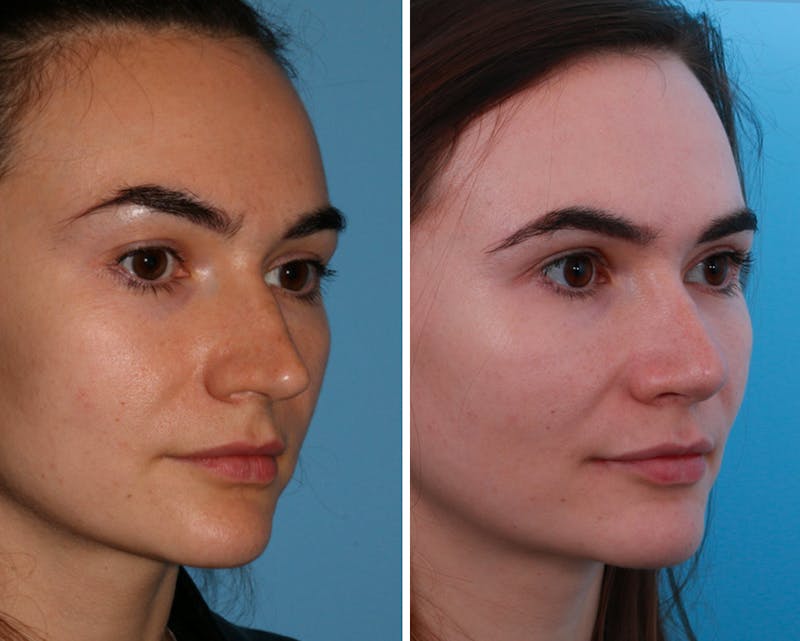 Rhinoplasty Before & After Gallery - Patient 64081018 - Image 1