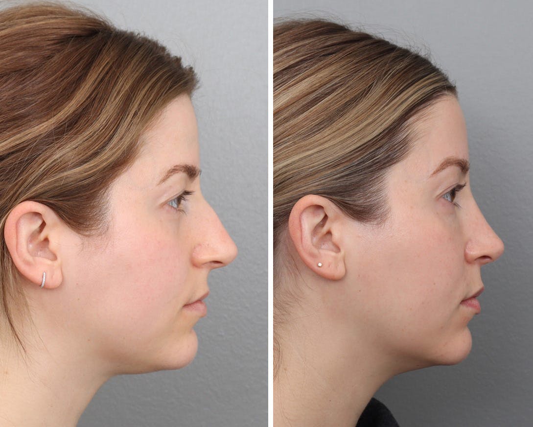 Rhinoplasty Before & After Gallery - Patient 120285471 - Image 1