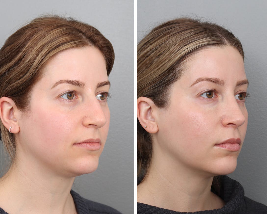 Rhinoplasty Before & After Gallery - Patient 120285471 - Image 2